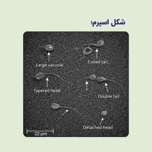 چرا ظاهر اسپرم در باروری اهمیت دارد؟