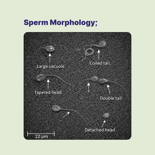 Why Does Sperm Shape Matter in Fertility?